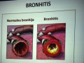 Bronhitis