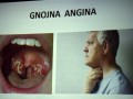 Gnojna angina