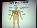 Gripa – znaki bolezni