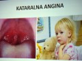 Kataralna angina