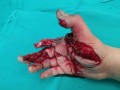 Poškodba roke