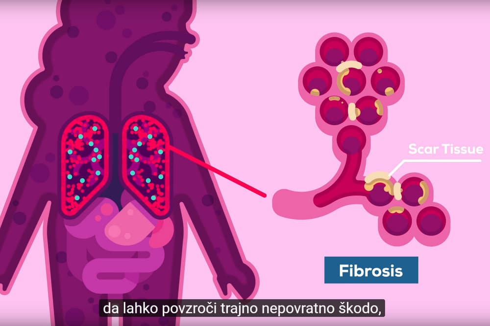 Kaj se dejansko zgodi, ko koronavirus okuži človeka?