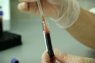 V Sloveniji je bil potrjen osmi primer okužbe s koronavirusom