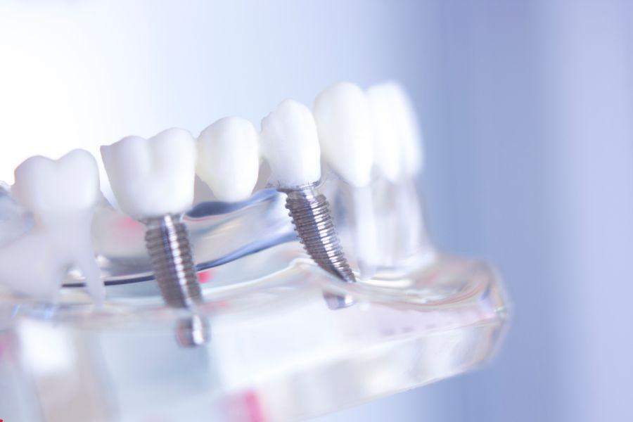 Zobni vsadki orthodental