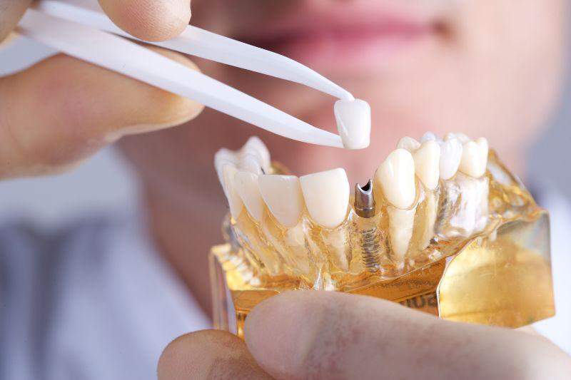 Zobni implantati