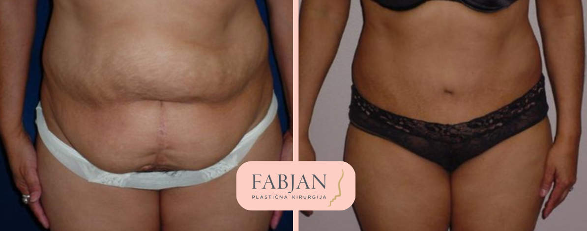 Estetika fabjan trebuh abdominoplastika